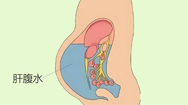 肝不好的人注意!肚子莫名变大,需小心肝腹水