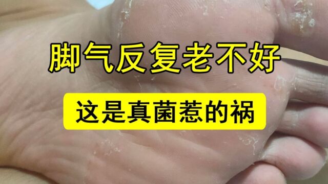 脚气反复老不好,这是真菌惹的祸教你简单处理