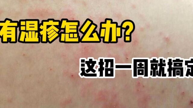 想要湿疹彻底治愈,学会以下这种方法,早点看完,早点摆脱舒服啊