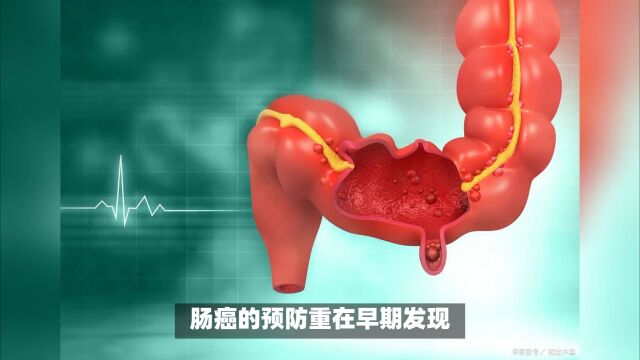 肠癌预警!早期诊断有哪些方法?