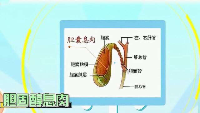 专家讲胆囊息肉:极易被忽视