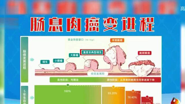 医生讲腺瘤性息肉的癌变过程