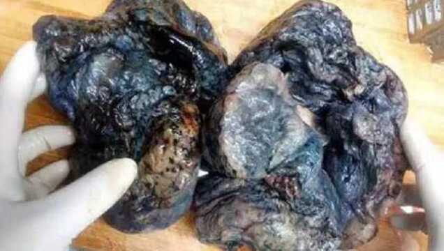 抽烟有多可怕来看看你的肺吧吸烟有害健康