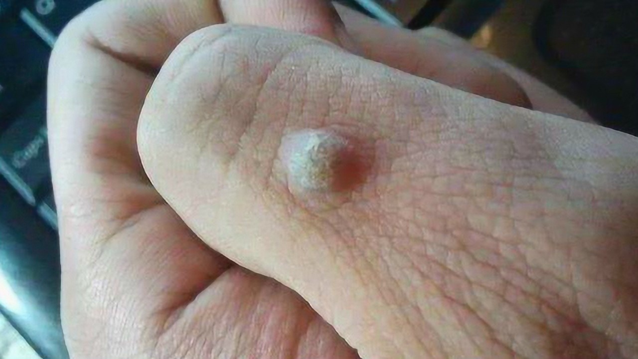 教你老方法,不痛不流血,瘊子自己脱