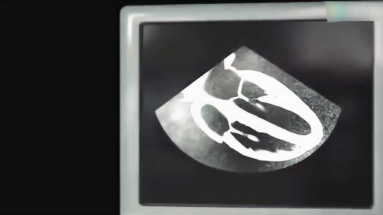 医学3D动画演示：2分钟看懂心脏超声心动图，俗称心脏彩超_高清