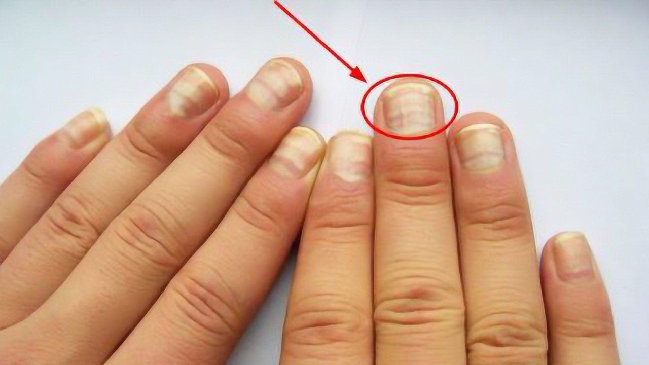 癌症早期指甲变化图片图片