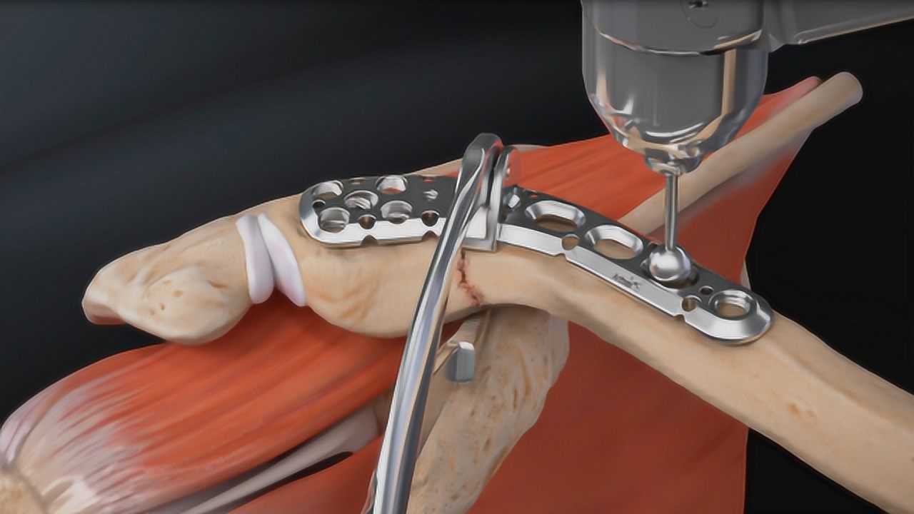 骨折后手术如何打钢板3d动画模拟全程隔着屏幕都觉得疼