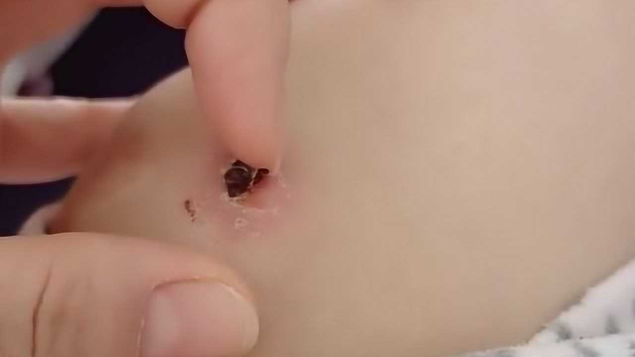 膝盖上的大血痂,真想把它扣下来,看着它我手就痒痒!