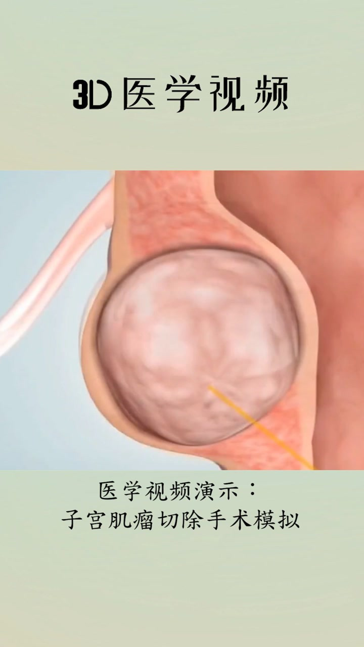 医学3d视频:子宫肌瘤切除手术模拟！_高清