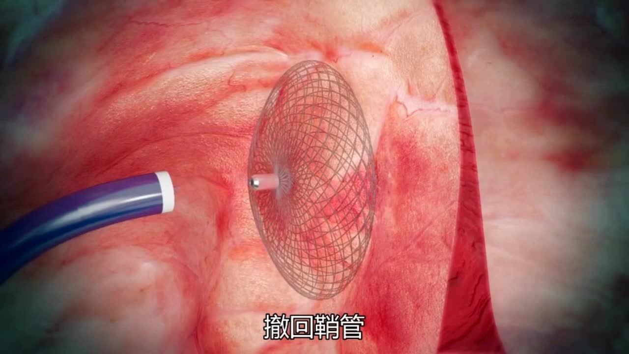 卵圆孔未闭手术过程图片