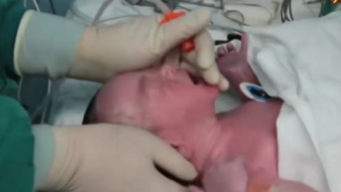 新生儿刚出生，就要通过脐带血管安装心脏起搏器，太让人心疼