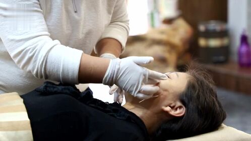 汉传针雕针灸美容面部提升实操教学美雕让您永葆青春