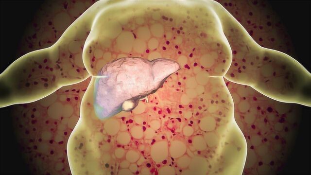 脂肪肝的诱因有哪些?医生:多与3个因素有关,大多数人能避开