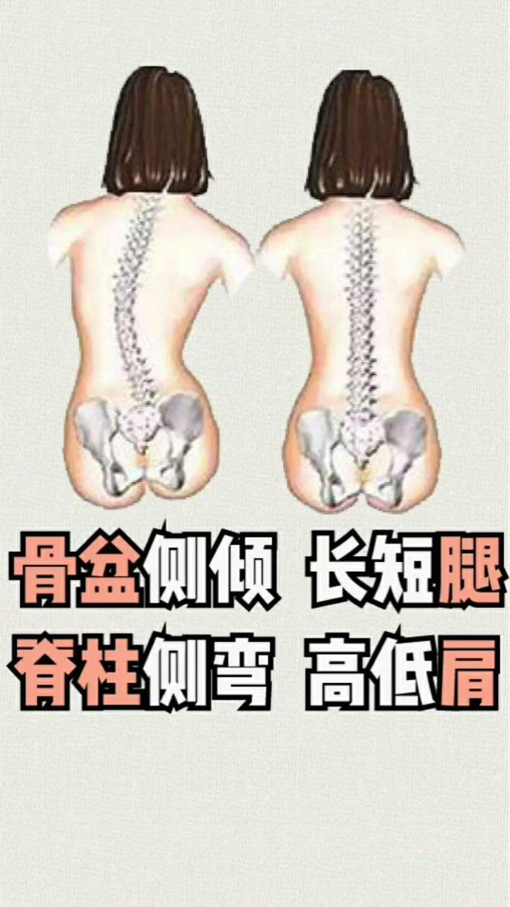 脊柱侧弯和长短腿阿七教你一招轻松搞定