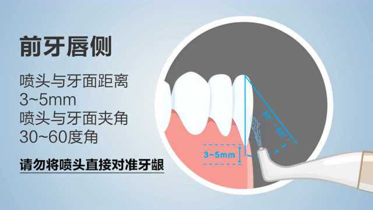 龈上喷砂动画演示_腾讯视频