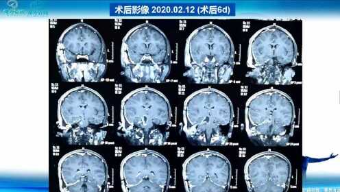 2020年03月02日-第8期-脑干弥漫性星形细胞瘤-WHO II级-新发病例