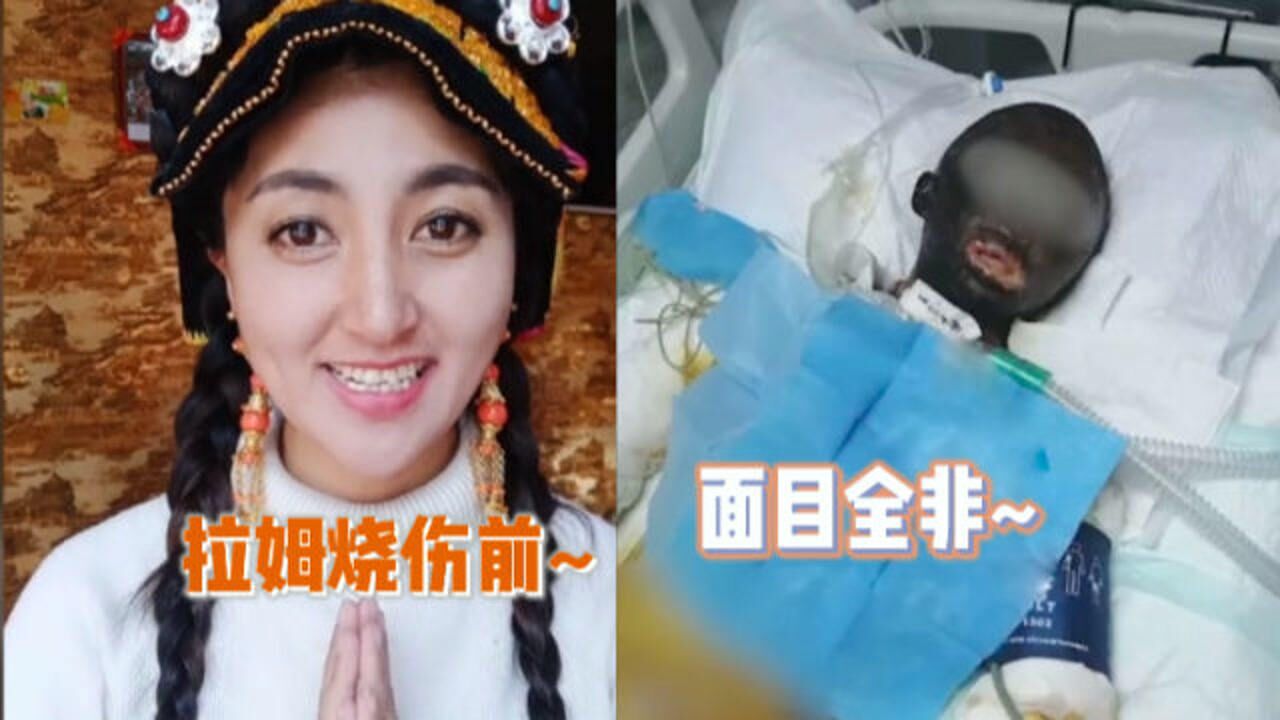恶魔在人间网红拉姆遭前夫纵火焚烧全身烧伤3小时致面目全非
