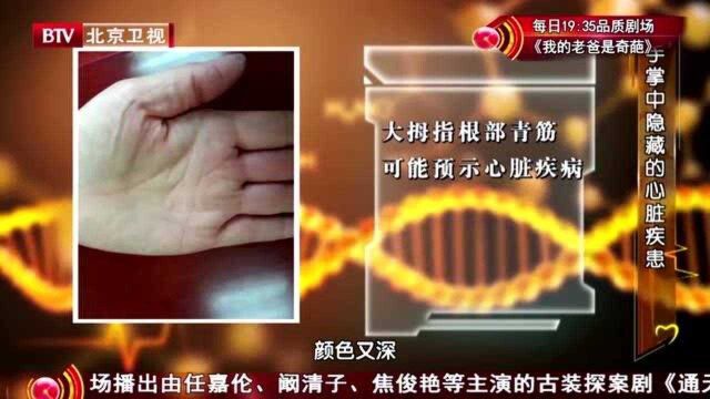 手掌的青筋预示着心脏病?专家讲解,把你的手掌摊开看看吧