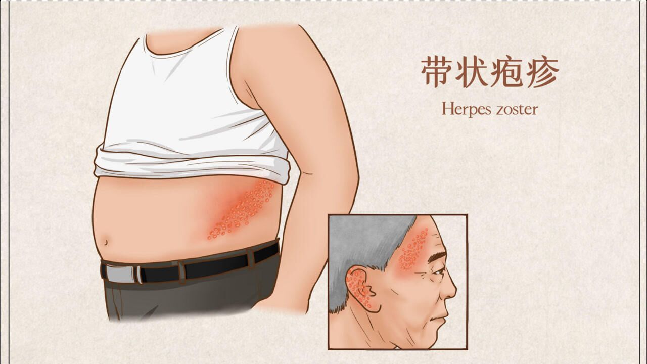 你可能是得了带状疱疹,自查这4个症状