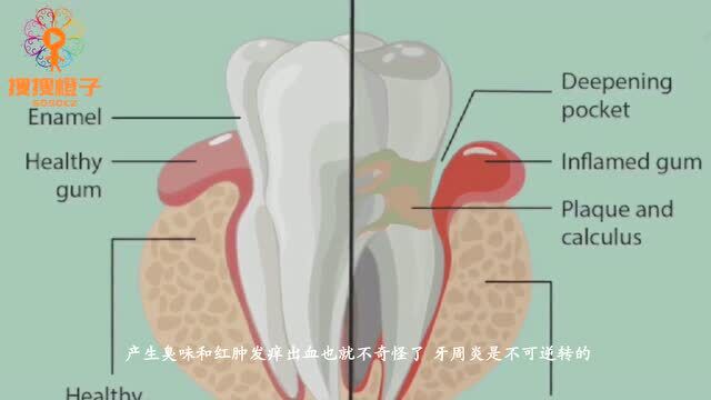 电动牙刷好还是普通牙刷好?冲牙器有用吗?牙龈炎和牙周炎怎么防