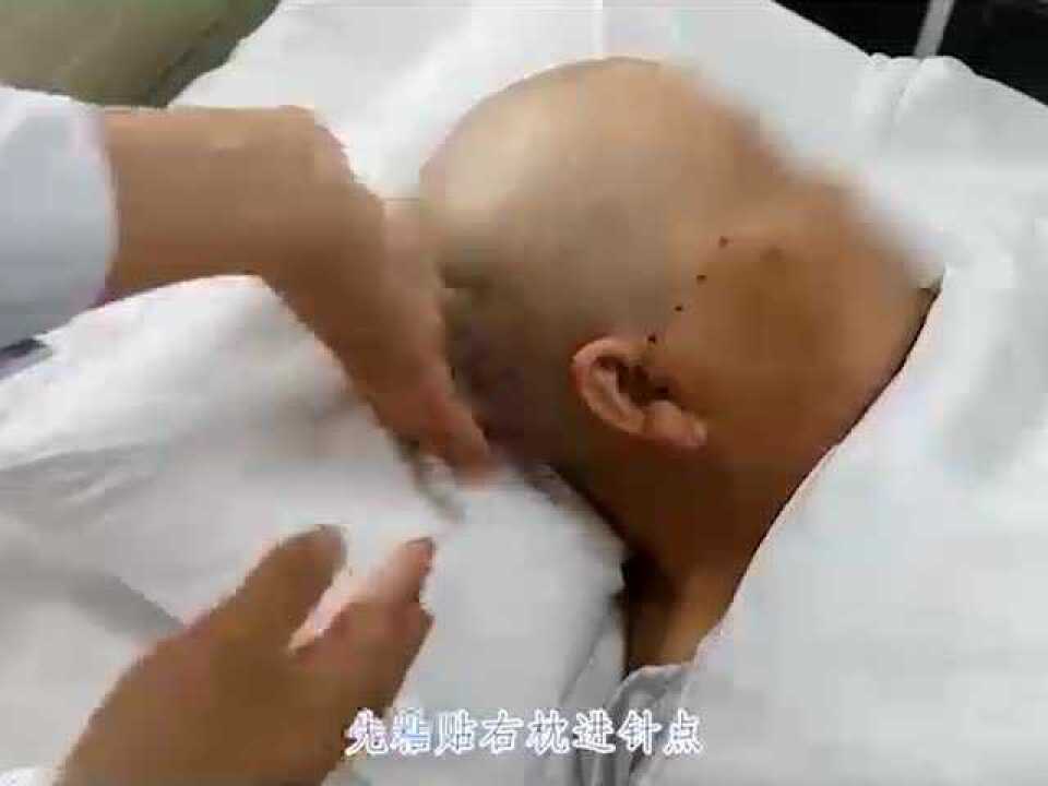 视频教程：新型颅脑手术头架引导下脑出血精准穿刺引流术_高清