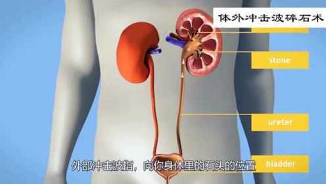 关爱健康小知识:什么是体外冲击波碎石术