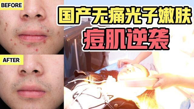 真人实测宝藏国产光子嫩肤,大烂脸竟然逆袭了?