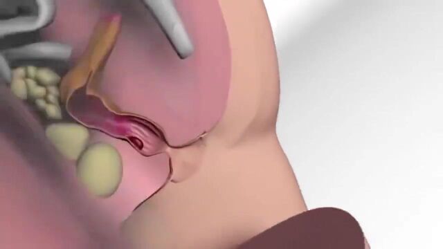 3D视频:痔疮手术,坐立不安,带入感太强了!