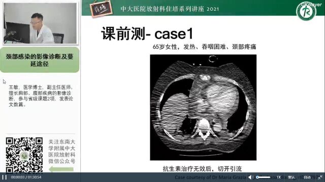 颈部感染的影像诊断及蔓延途径中大王敏