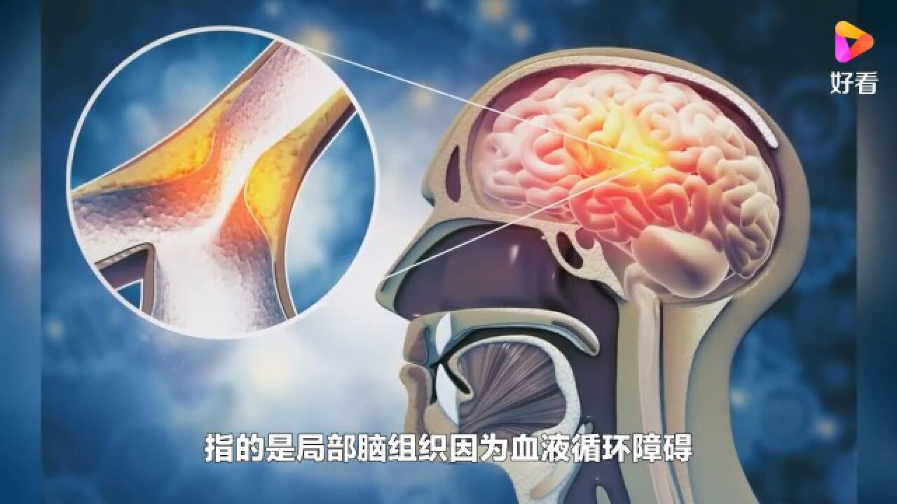 脑梗登门前,身体会不会有征兆?_高清1080P在线观看平台_腾讯视频