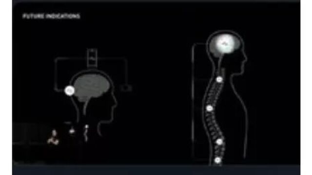 马斯克的脑机接口公司即将进行首次人体临床试验,帮助肢瘫痪患者
