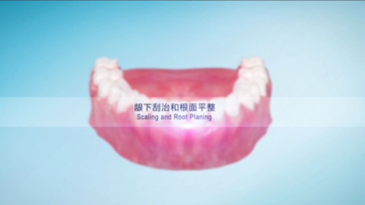 龈下刮治_高清1080P在线观看平台_腾讯视频