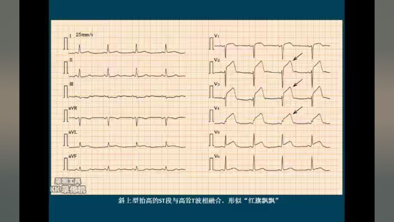 心电图词汇解释系列(三):st段抬高型心肌梗死 67