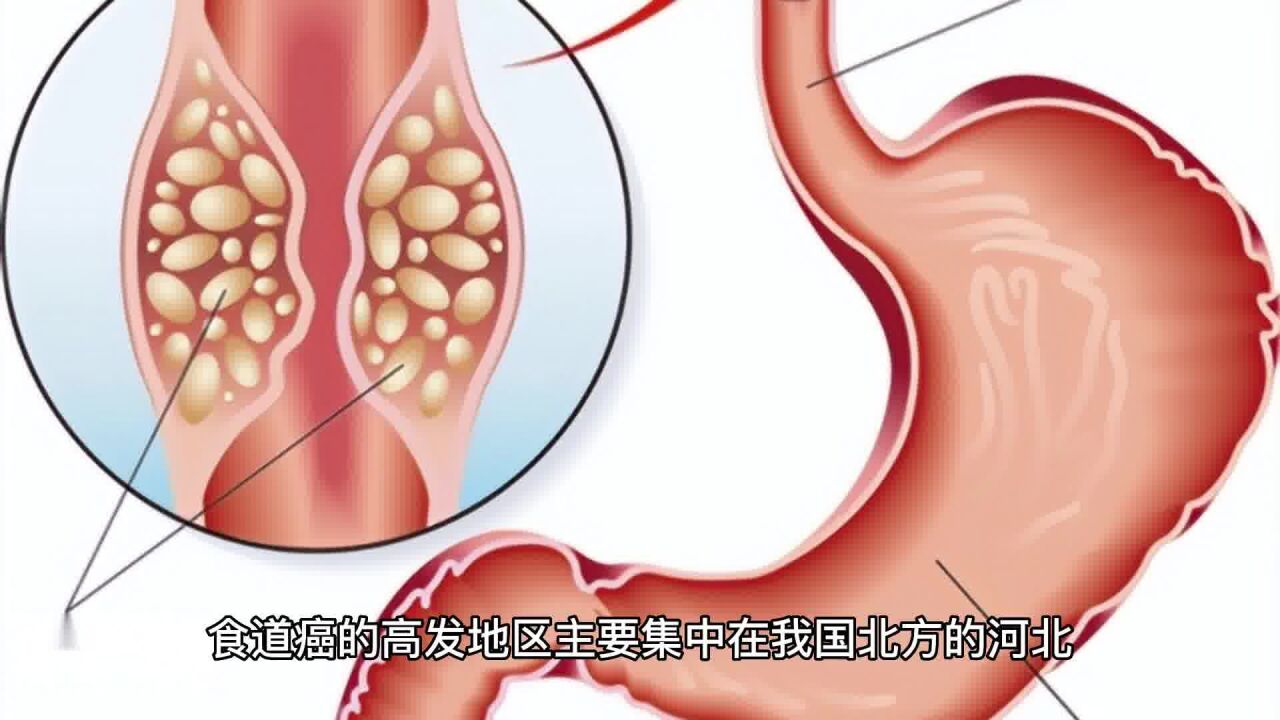 食道癌別再誤以為是咽炎了!這3個症狀,提前發現一個就很好