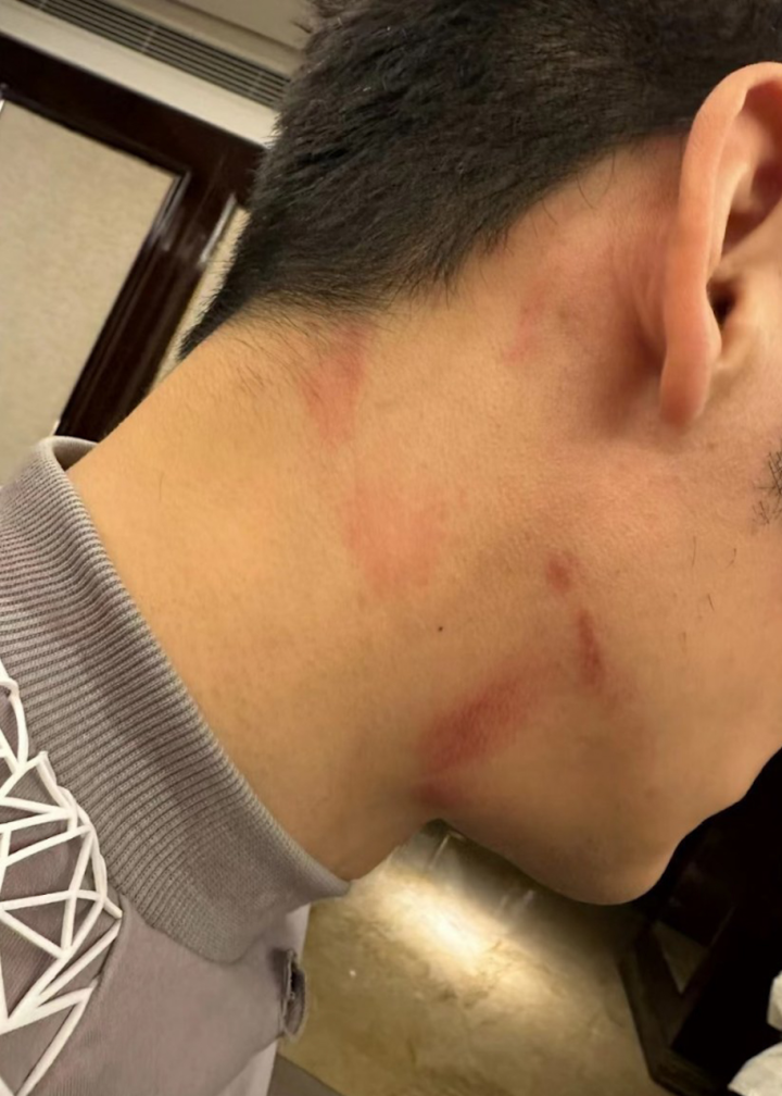 44岁李晨被曝录节目时脖子上出现红色吻痕,工作室回应:放过他吧,小伤