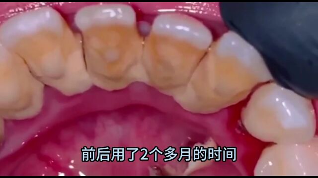 牙结石清理全过程分享!洗完像换了一口牙!#超解压视频#强迫症