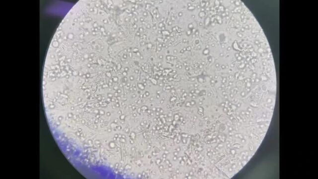 白带常规中的线索细胞是什么有何临床意义