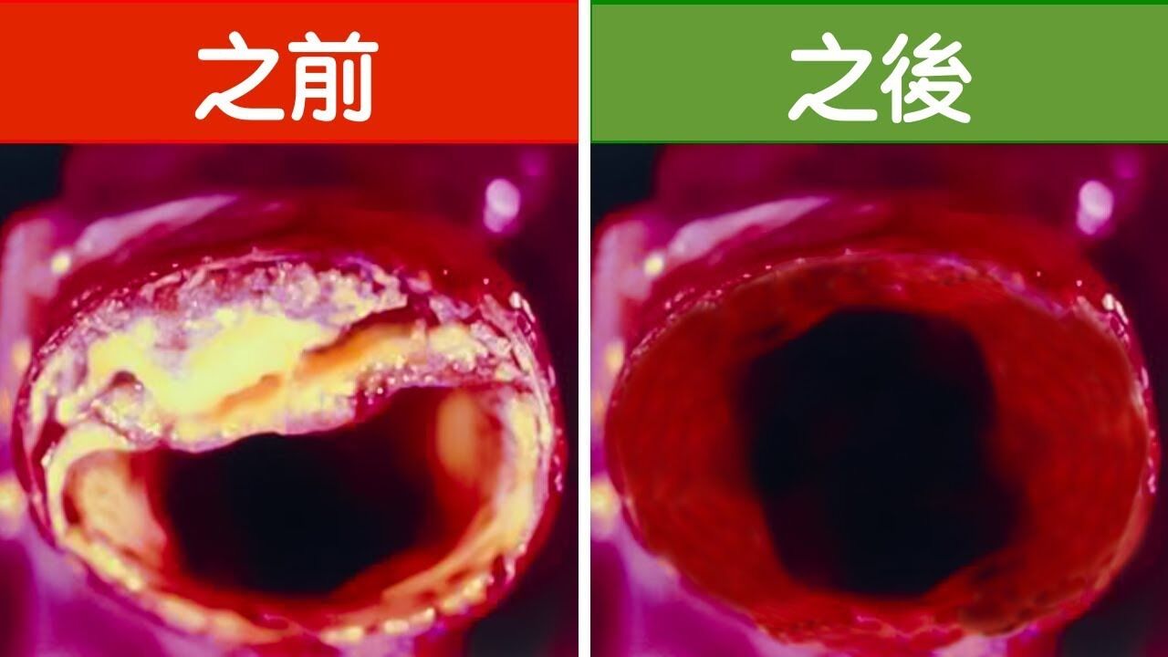 清血管的最好食物,預防血管硬化,柏格醫生DrBerg_高清1080P在线观看平台_腾讯视频