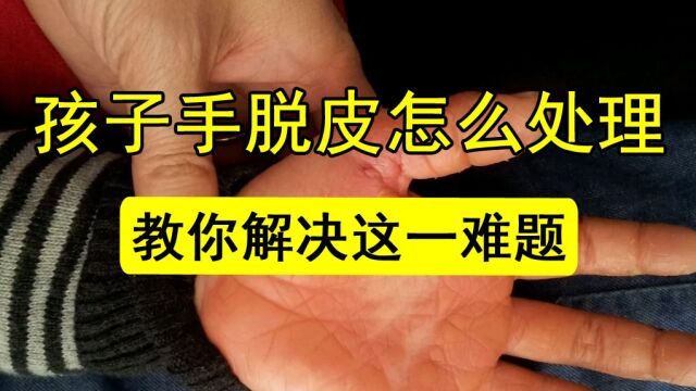 孩子手脱皮怎么处理?今天教大家如何解决这一难题!