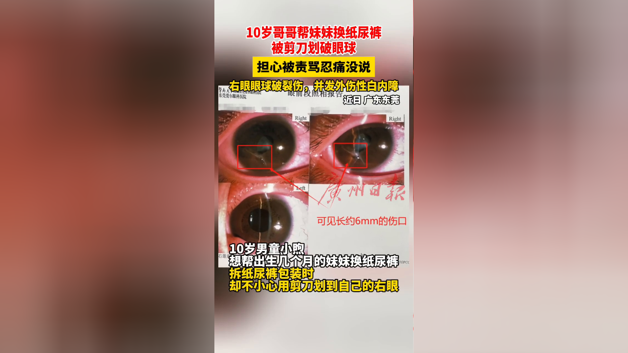10岁哥哥帮妹妹换纸尿裤时被剪刀划破眼球 担心被骂忍痛没说
