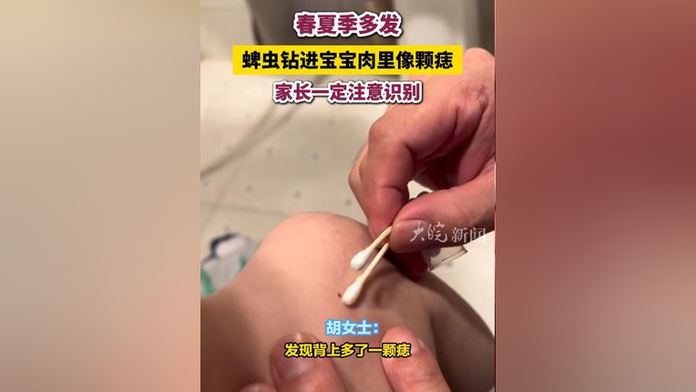 蜱虫钻进宝宝肉里像颗痣 家长一定注意识别