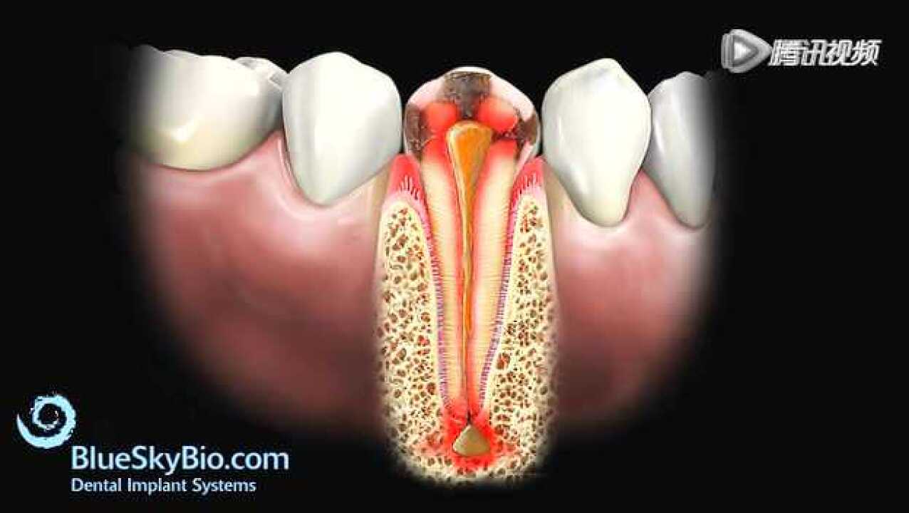 残冠桩核冠修复_高清1080P在线观看平台_腾讯视频