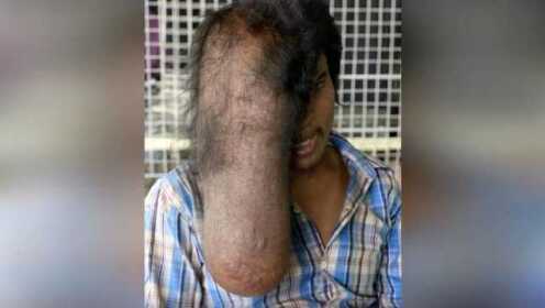 柬埔寨一男子脸部长巨瘤如“象人”
