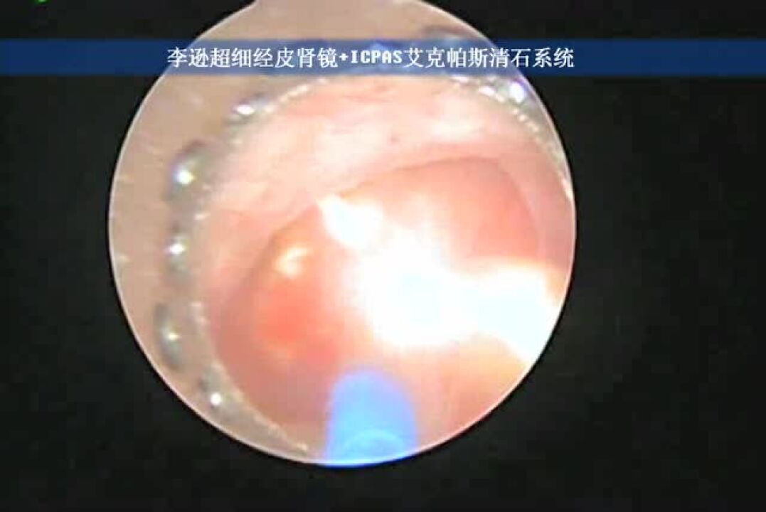 沈大内窥镜手术视频_腾讯视频