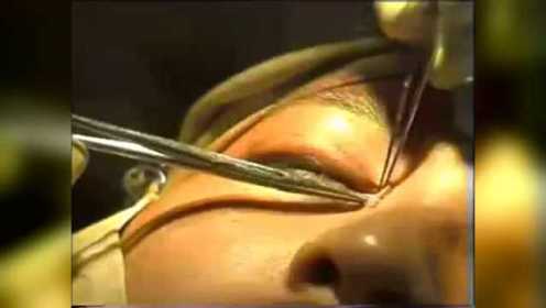 双眼皮埋线，整形手术视频