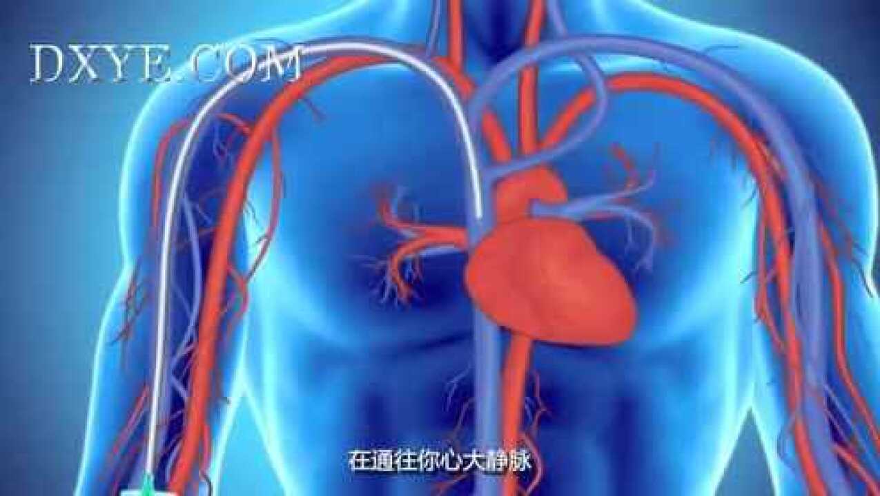 丁香叶医学健康科技专辑-2_PICC外周插入中心静脉导管_高清1080P在线观看平台_腾讯视频