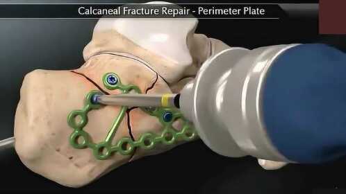 3d动画演示,跟骨骨折的手术治疗,原来钢钉是这么打上去的!