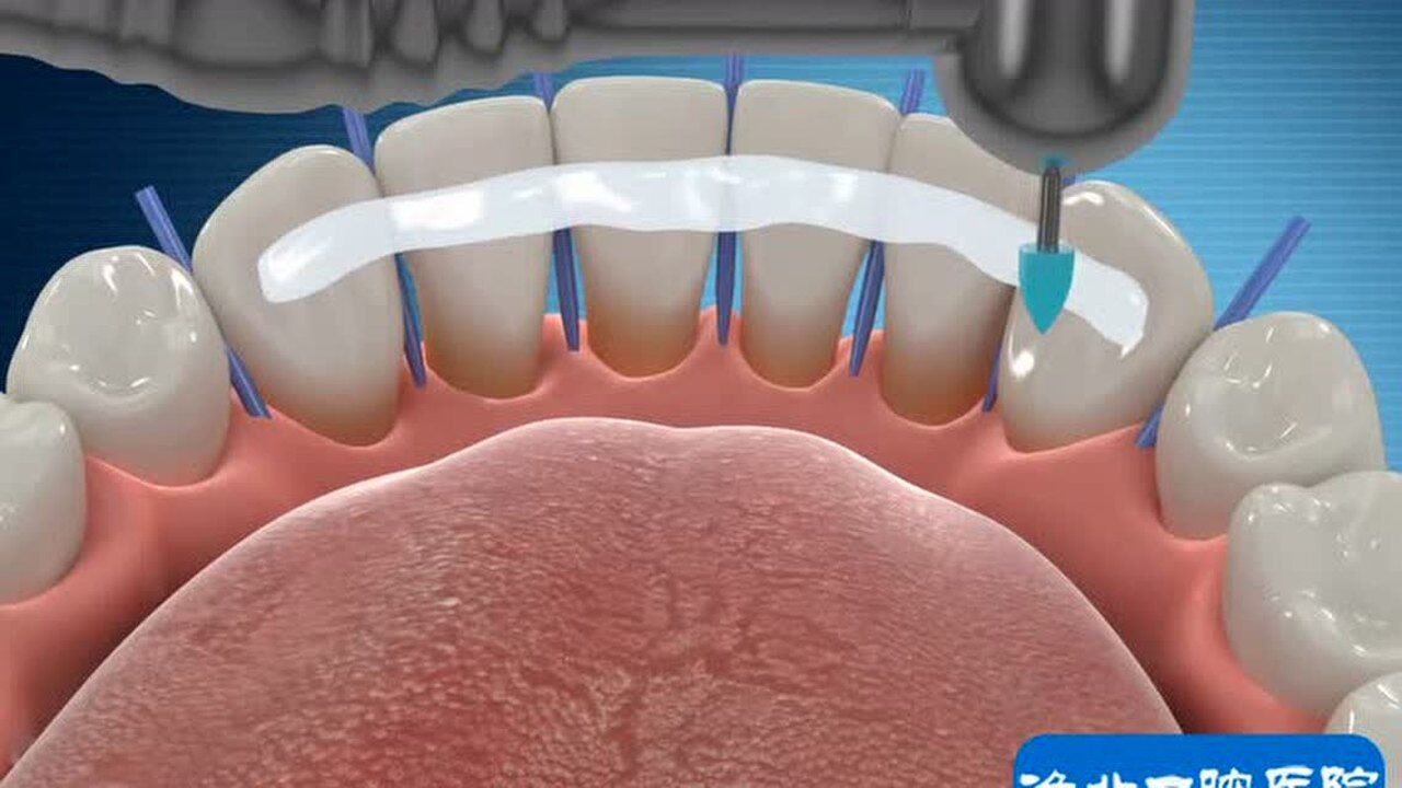 树脂牙周夹板固定图片图片