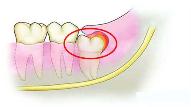 人为什么会长智齿?长出来要不要拔掉?幸亏知道的早