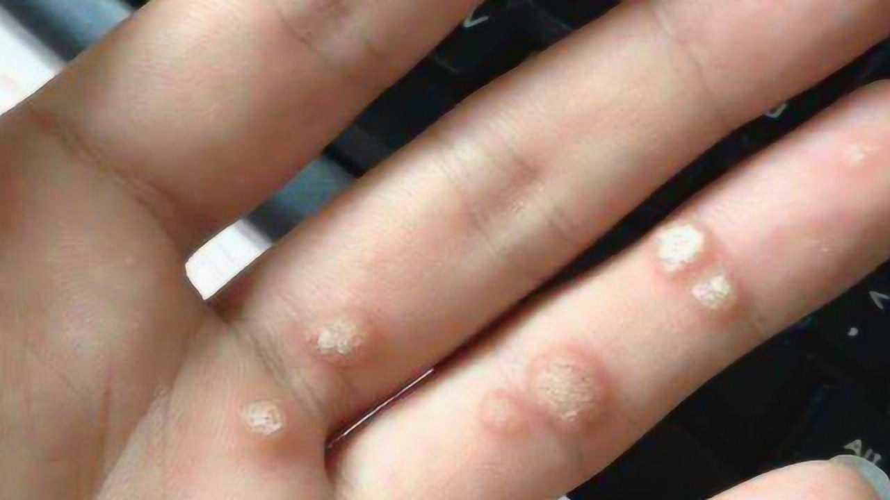 原来去除瘊子就是这么简单,省钱又省力,可惜现在才知道!